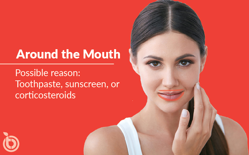 Acne Around the Mouth Causes